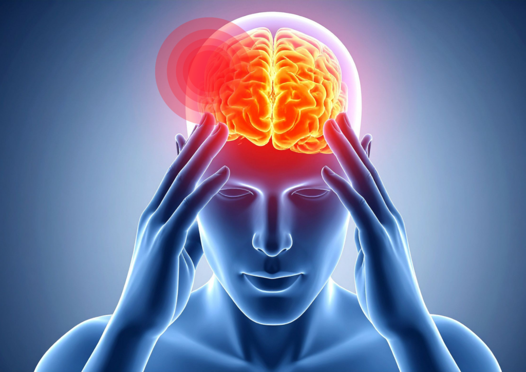 Illustration of migraine pain distribution across the head